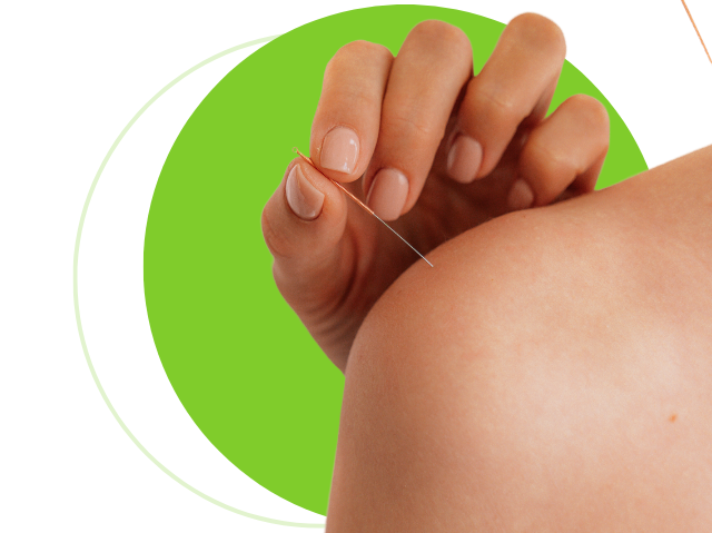 Acupuncture at Arise Physio
